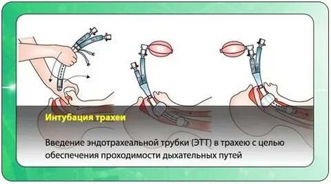 Уход за интубационной трубкой