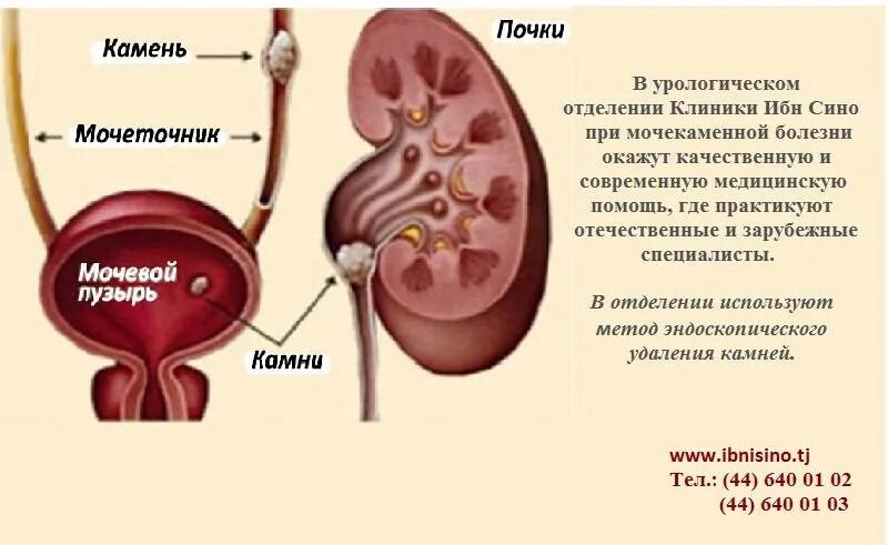 После мочевого. Камни в почках и мочевом пузыре. Мочекаменная болезнь мочевого пузыря. Схема выхода камня из почки у мужчин. Выход мочеточника в мочевой пузырь.