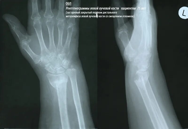 Рентген лучезапястный сустав перелом лучевой кости. Перелом метаэпифиза лучевой кости рентген. Рентген перелома лучевой кости руки. Внутрисуставной перелом лучевой кости.