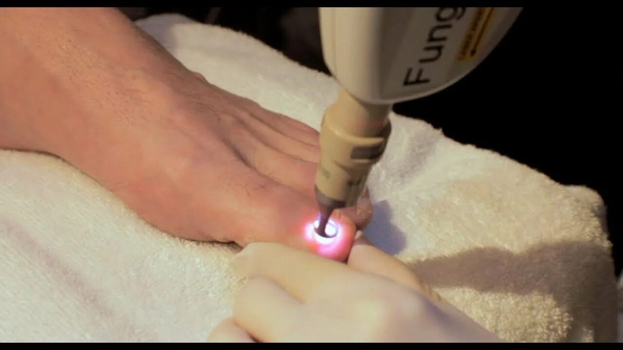 How to treat an ingrown nail 2023 Хитрости жизни VK