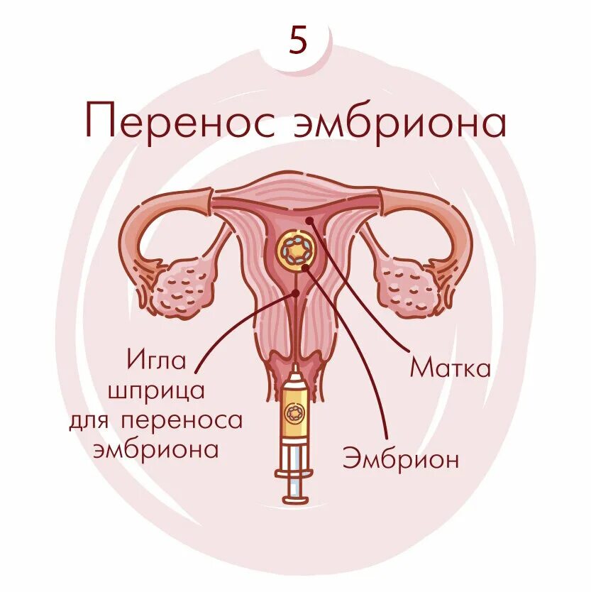 Как подсаживают эмбрион. Перенос эмбриона в матку. перенос эмбрионов при эко. перенос эмбриона в матку при эко.