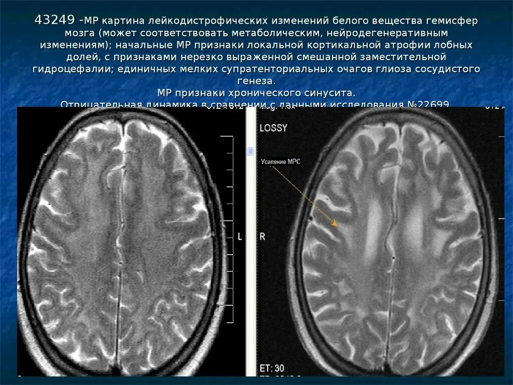 Очаг в лобной доле сосудистого генеза