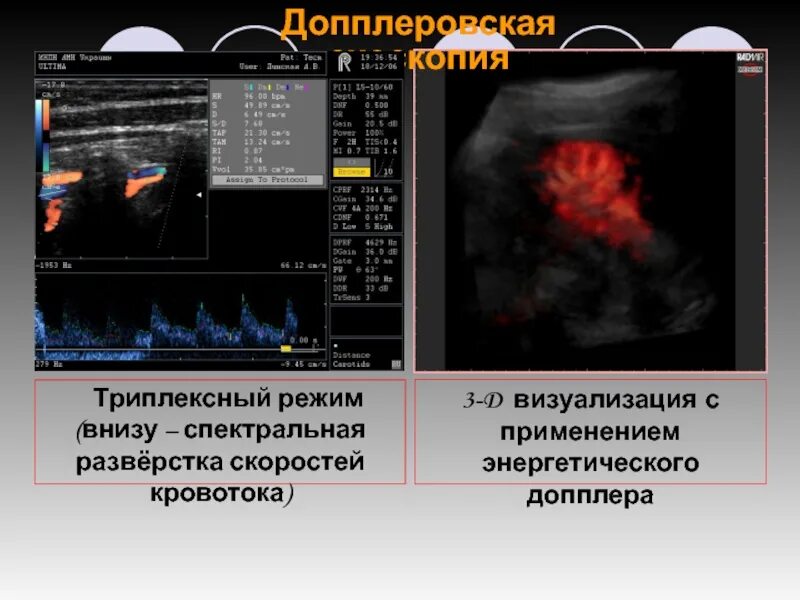 Режим снизу. Спектральный допплер. Триплексный режим. Триплексный допплер. Спектральный допплеровский режим ограничения.