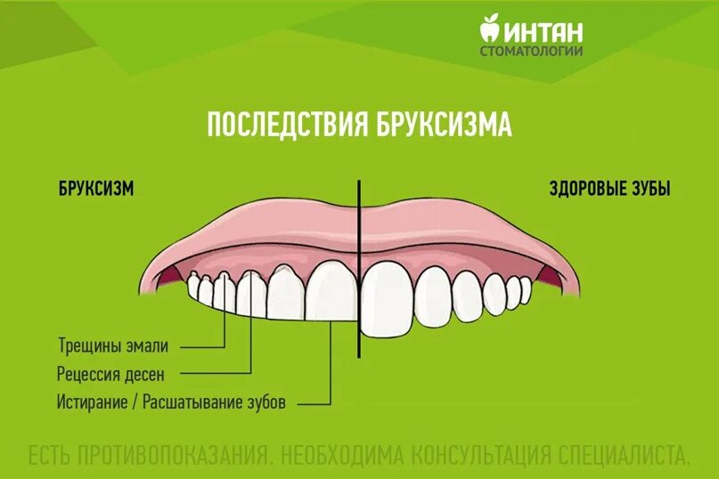 Стучать зубами причины. Бруксизм скрежетание зубами. Последствия бруксизма.