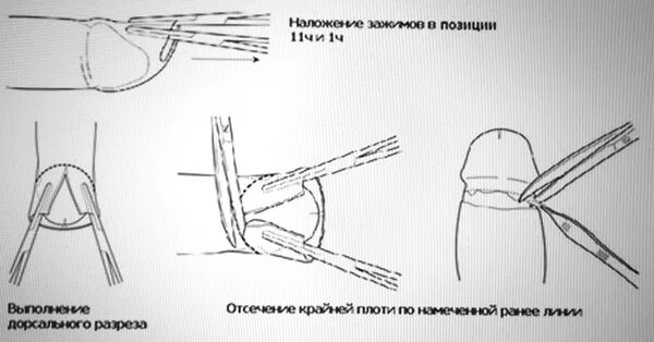 Головка у мужчин. Циркумцизио (обрезание крайней плоти) (схема 2). Уздечка после циркумцизии. Операции при фимозе и парафимозе.