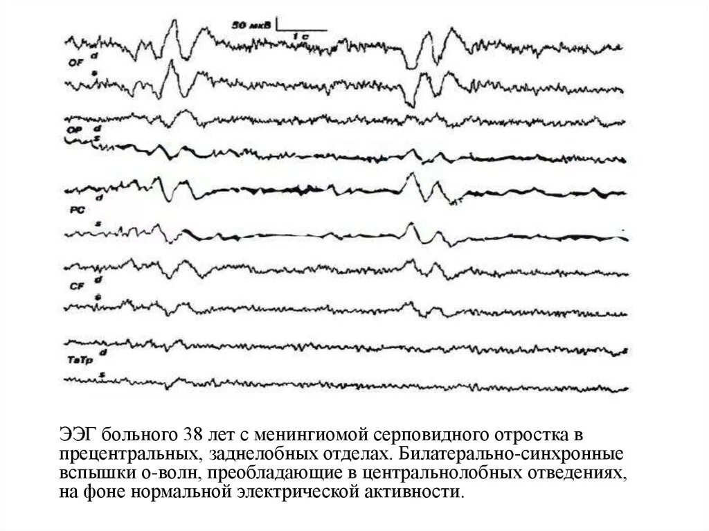 Луки ээг. Вертексные потенциалы на ЭЭГ. Полифазные потенциалы на ЭЭГ. Вертексные волны на ЭЭГ. Вертекс потенциалы на ЭЭГ У ребенка.