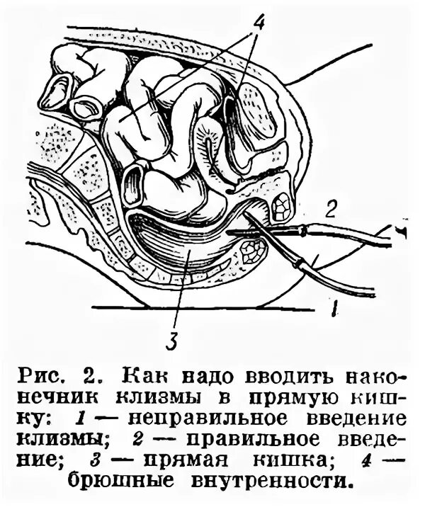 Как вводить клизму. Введение наконечника при очистительной клизме. как правильно вводить наконечник при клизме. введение наконечника клизмы. ввод в прямую кишку.