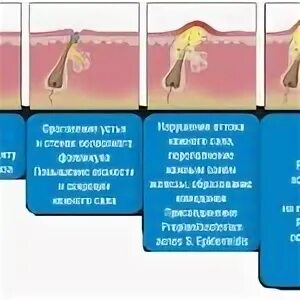 Стадии прыща