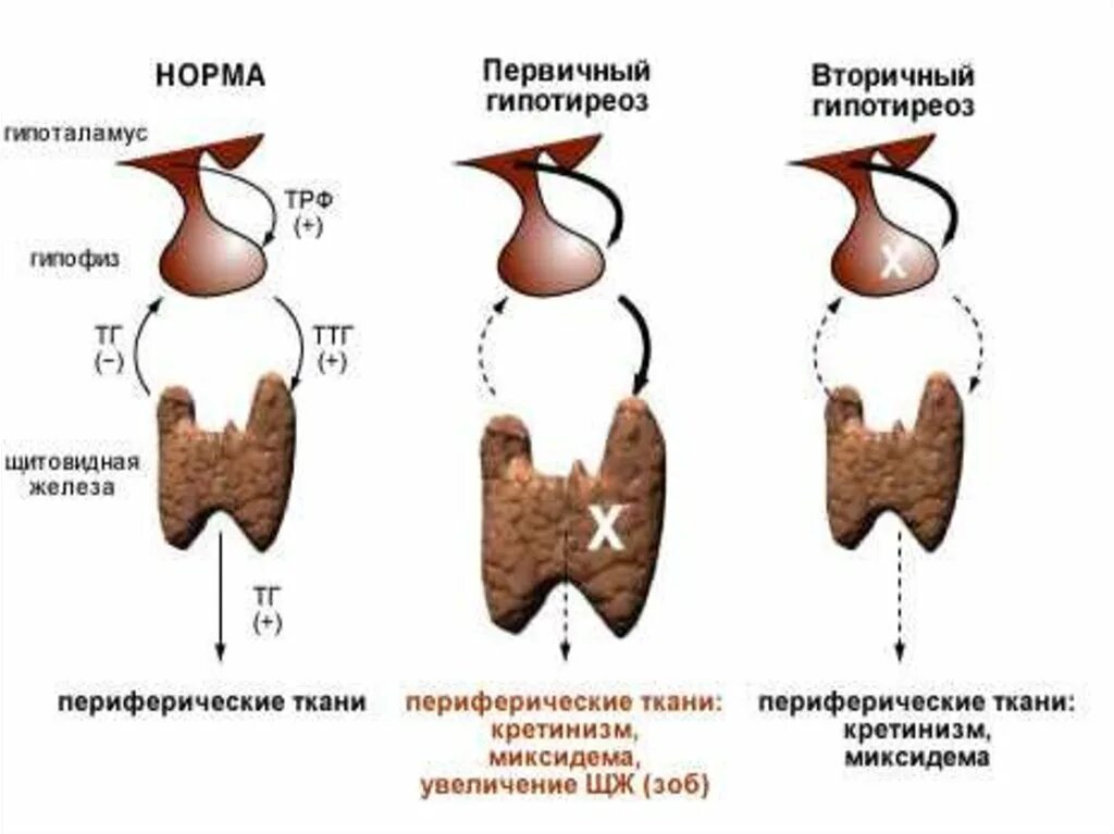 Заболевания при гипофункции щитовидной железы. Гипотиреоз первичный вторичный третичный. Гипотиреоз щж. Снижена функция щитовидной железы. Вторичный врожденный гипотиреоз.