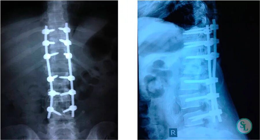 Компрессионный перелом позвоночника l1. Компрессионный перелом позвоночника т11. Компрессионный перелом позвоночника th-5-6. Компрессионный перелом тела т11 позвонка. Лечение позвоночника после операции