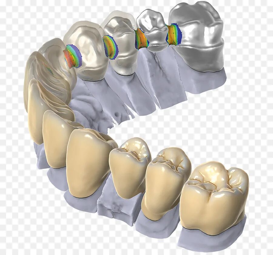 Моделирование реставрации. Cad cam стоматология exocad. моделировка exocad моделирование зубов. диоксид циркония cad cam 3d exocad. cad cam технологии в ортопедической стоматологии.
