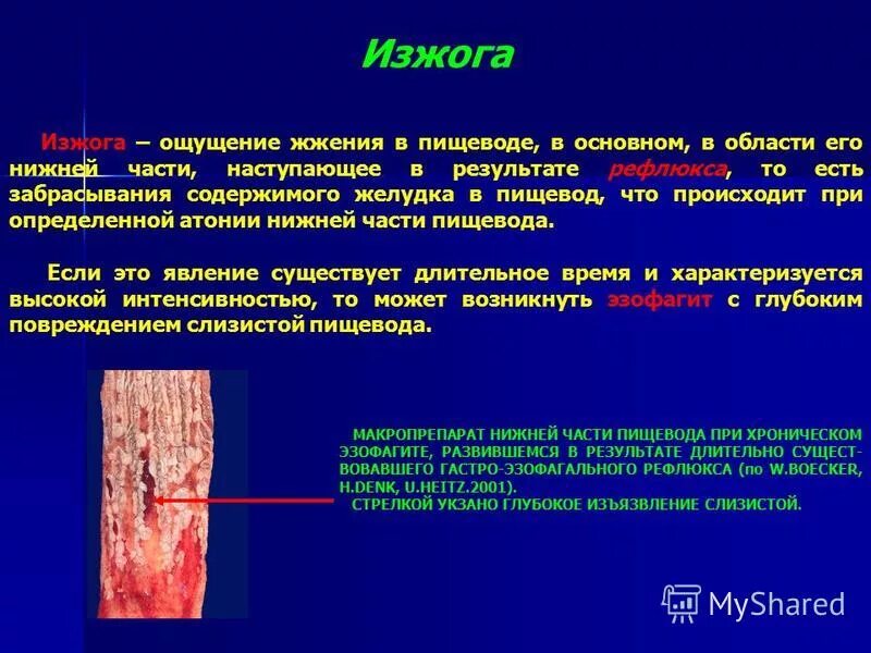 Жжение в области пищевода. Жжение в области нижней части пищевода. Неприятные ощущения в пищеводе жжение.