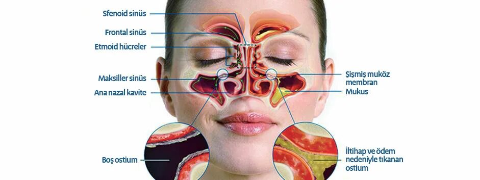 Синусит можно греть нос. Заболевания носовых пазух. Синусит клиновидной пазухи. Аутоимунный лейкоз лобной пазуха. Инфекция носа и околоносовых пазух поражения.