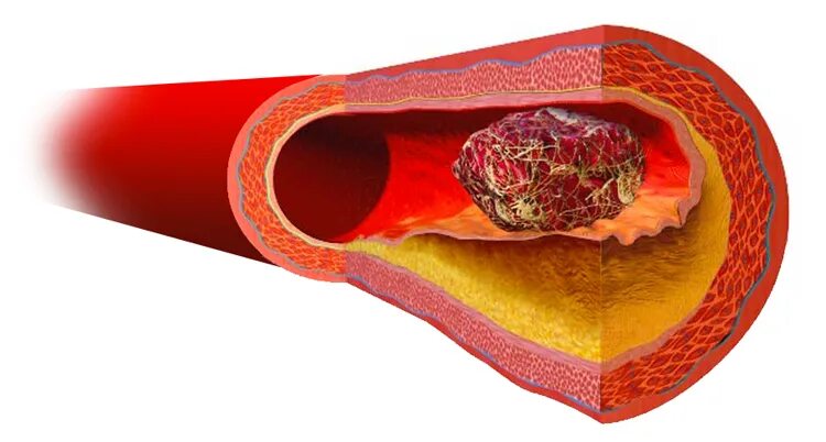 капилляры тромбы. тромбоз и атеросклероз сосудов. капилляры тромбы. капилляры тромбы. тромбоз и эмболия и атеросклероз.