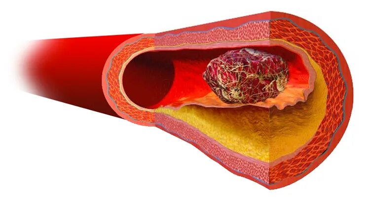 Тромбоз кровеносных сосудов. Закупорка артерии тромбом. Закупорка кровеносных сосудов. Тромб и бляшка разница