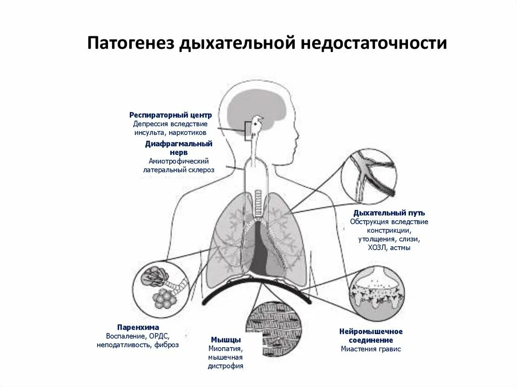 Механизм развития острой дыхательной недостаточности. Схема патогенеза острой дыхательной недостаточности. Причины острой дыхательной недостаточности схема. Синдром дыхательной недостаточности причины.