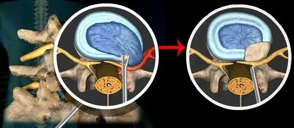 Эндоскопическая дискэктомия грыжи позвоночника. Грыжа межпозвонкового диска операция. Шейная эндоскопическая дискэктомия. Дискэктомия поясничного отдела l5-s1. Грыжа позвоночника после операции что делать