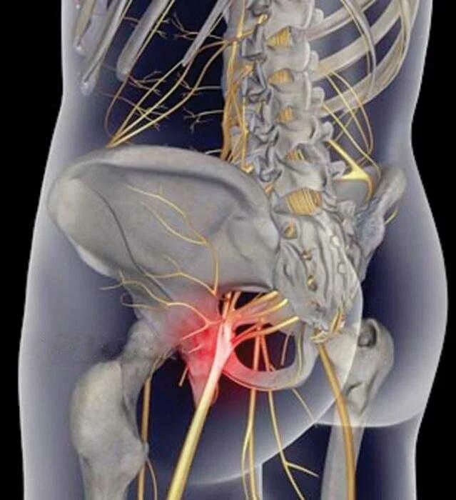 дорсалгия ишиас. признаки воспаления седалищного нерва у женщин симптомы. лечебная блокада седалищного нерва. поражение седалищного нерва симптомы. ишиас седалищного нерва.