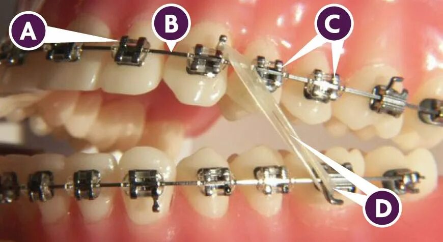 Самоподтягивающиеся брекеты. Ретинированный клык брекеты. Аппарат форсус ортодонтия. Элайнеры invisalign. Ставят ли брекеты если нет одного зуба.