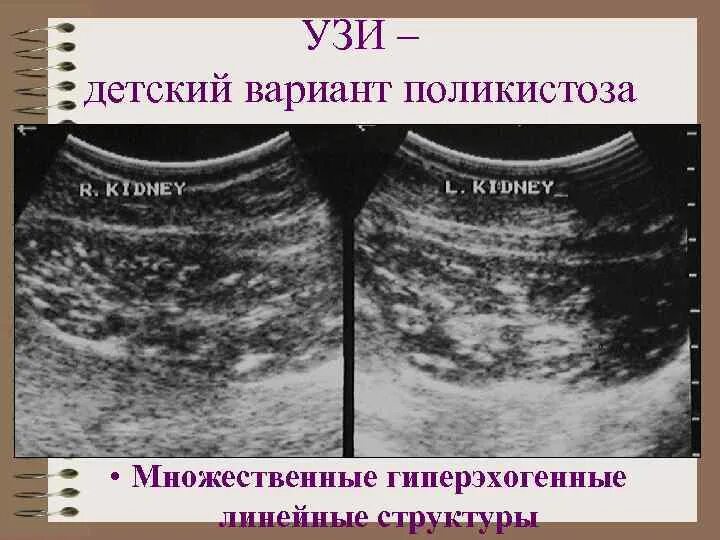 Гиперэхогенным округлым образованием. Гиперэхогенные структуры. Гиперэхогенная структура. Гиперэхогенные структуры на УЗИ. Гиперэхогенные включения в матке.