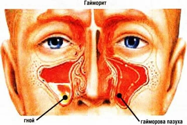 Гайморит носа. Гайморовые пазухи, гайморит. Расположение гайморовых пазух на лице.