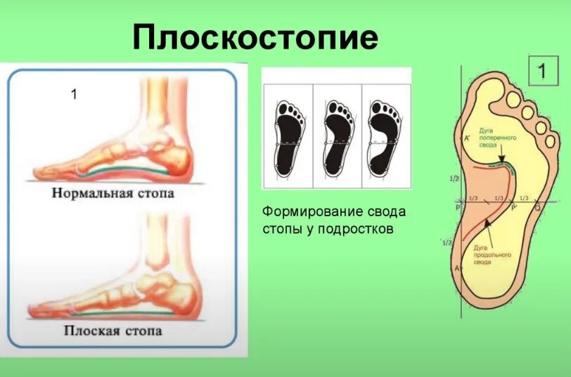 Сформировались своды. Нормальное формирование свода стопы. Плоскостопии. Типы плоскостопия. Свод стопы при плоскостопии.