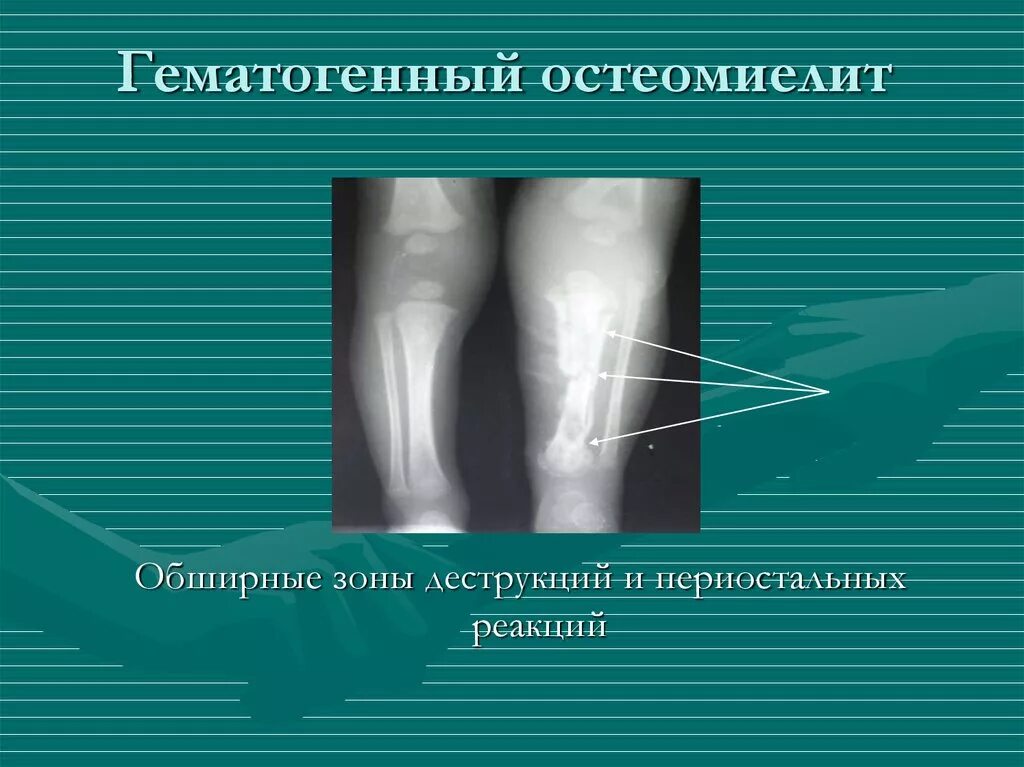 Зона деструкции