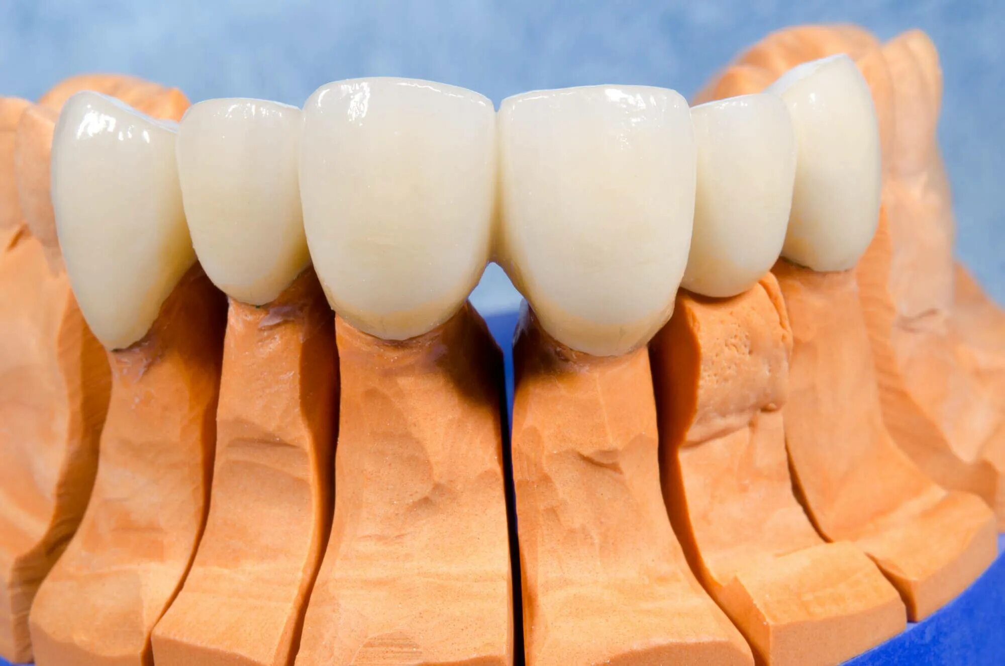 Несъёмный мостовидный протез челюсти. Диоксид циркония мостовидный протез. Мостовидный протез керамика. Металлокерамические зубные коронки. Металлокерамический зубной мост.