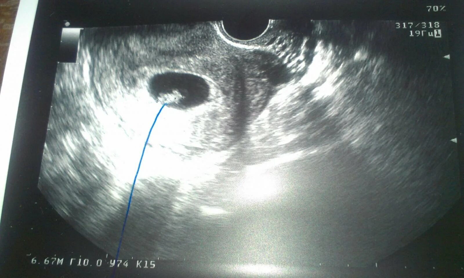 Плодное яйцо 3 мм. Плодное яйцо 3мм и желточный мешок 3мм. плодное яйцо 16мм,эмбрион 6мм. плодное яйцо 19 мм желточный мешочек 3 мм.