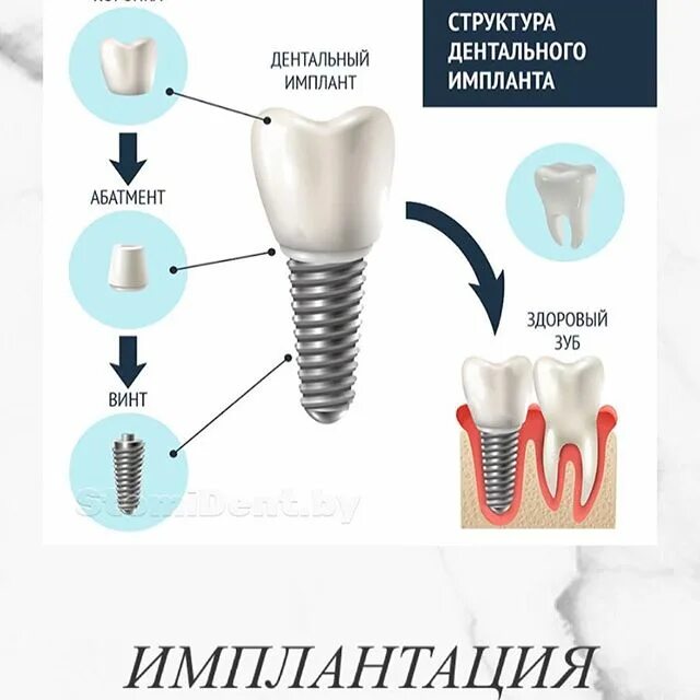 имплант зуба по омс