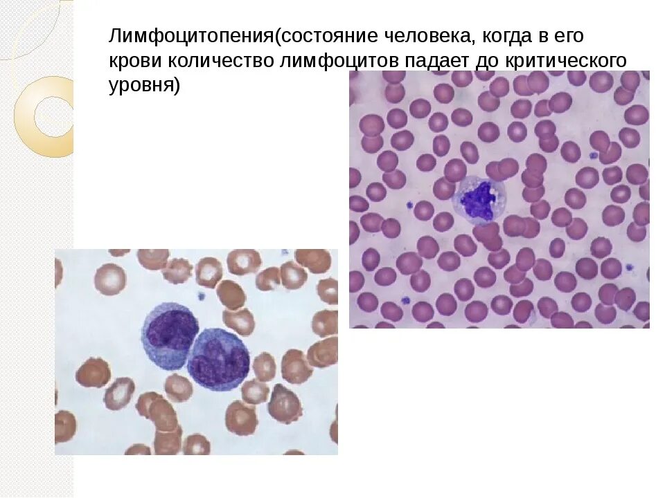 Патология лимфоцитов лимфоцитоз лимфопения. Лимфоцитопения картина крови. Абсолютная лимфоцитопения. Лимфоцитопения причины. Лимфопения крови