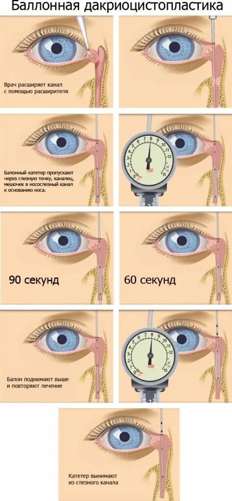 Как пробивают слезный канал. Массаж при непроходимости слезного канала схема. Закупорка слезного канала у взрослого операция. Техника массажа носослезного канала. Массаж при закупорке слезного канала.