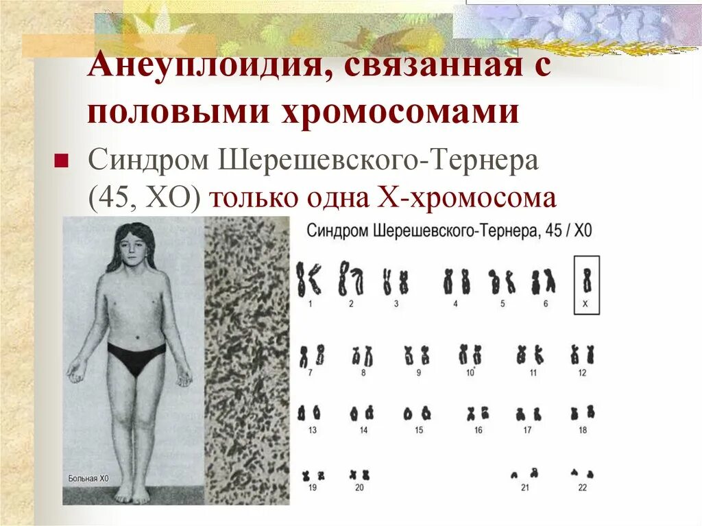 Отсутствие х хромосомы у мужчин. Анеуплоидия половых хромосом. Хромосомная анеуплоидия. Анеуплоидия по половым хромосомам. Анеуплоидия по половым хромосомам у девочек.
