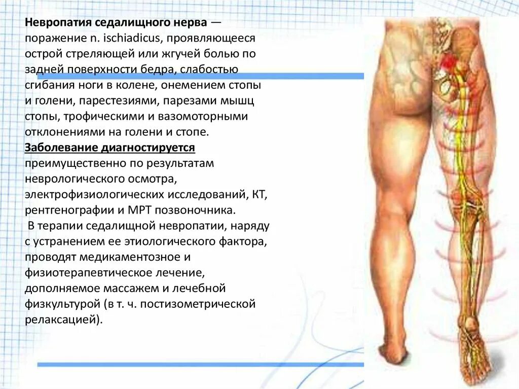 Поражение нервов нижних конечностей. Синдром поражения седалищного нерва. Туннельная нейропатия седалищного нерва. Невропатия седалищного нерва симптомы. Клиника поражения седалищного нерва.