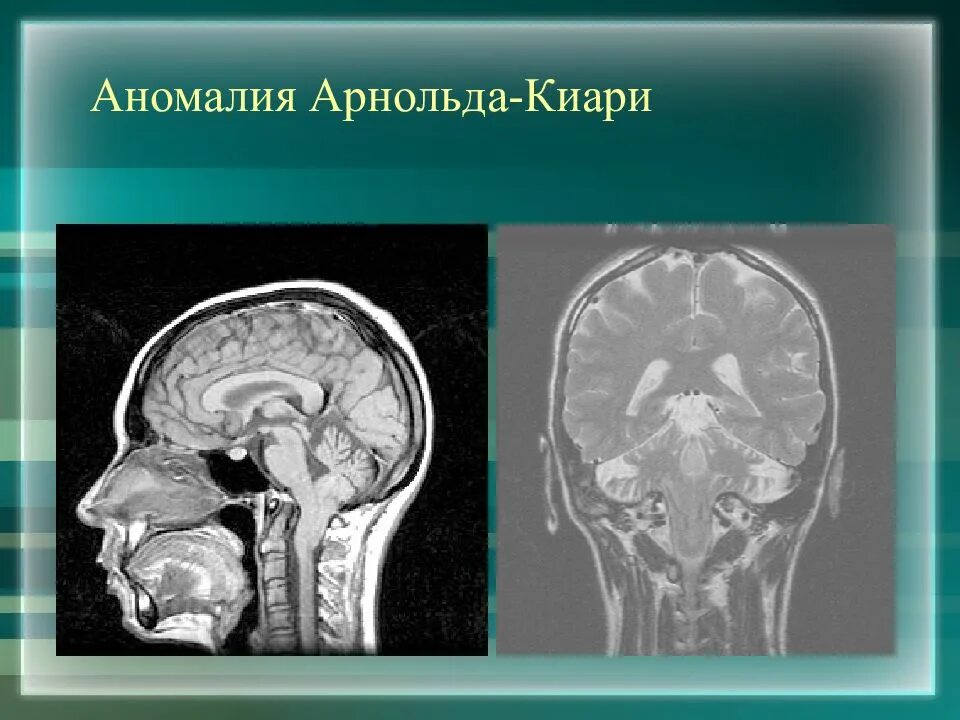 Аномалия киари степени. Аномалия Арнольда Киари операция. Мальформация Арнольда-Киари 2 типа. Мальформация Арнольда-Киари 3 степени.