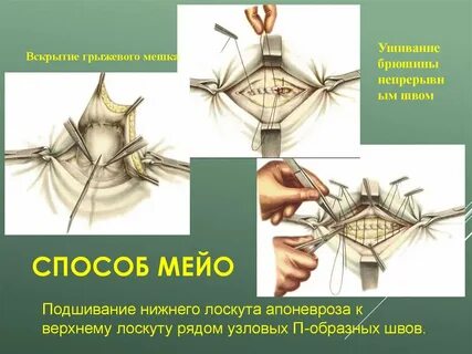 Пупочная грыжа методы операции