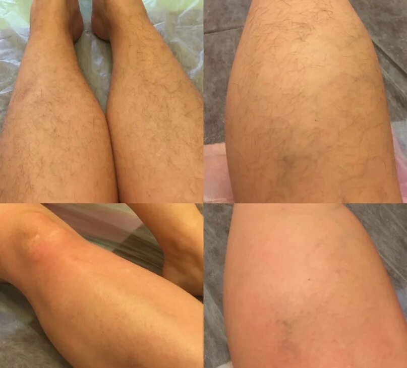 Шелковистая кожа тела. Лазерная эпиляция. Лазерная эпиляция ног. Эпиляция ноги полностью. Лазерная эпиляция ноги полностью.