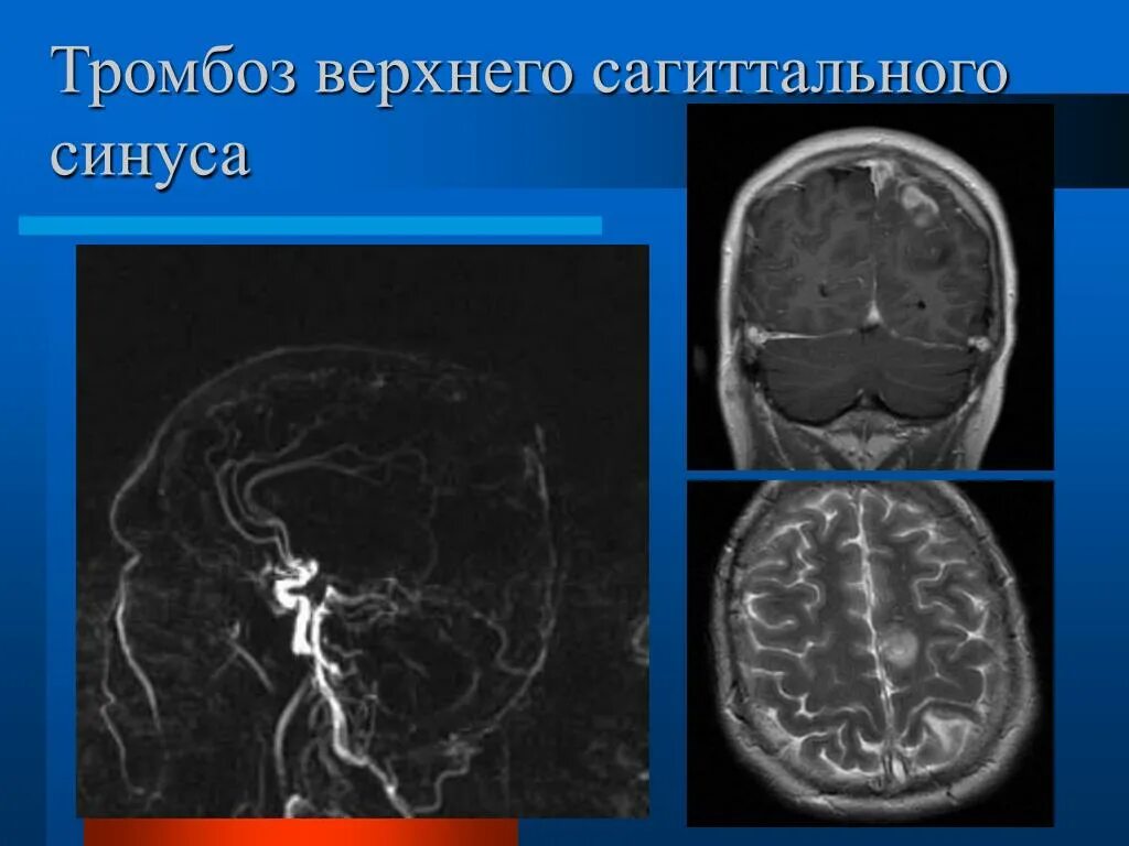 Синус тромбоз диагностика. Тромбоз верхнего сагиттального синуса кт. тромбоз кавернозного синуса кт. тромбоз венозного синуса на кт. тромбоз венозного синуса мрт.