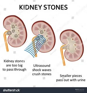 Выходит песок из почек что делать