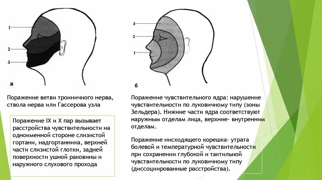 Зоны иннервации ветвей тройничного нерва, зоны Зельдера. Синдром поражения нисходящего ядра тройничного нерва. Зоны чувствительности на лице. Сегментарный Тип нарушения чувствительности на лице. Типы поражения нервов