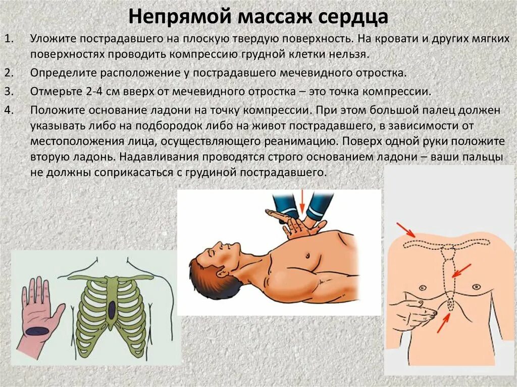 Частота надавливания при непрямом массаже. Непрямо1 массаж сердца. Непрямого массажа сердца мечевидного отросток грудины. Глубина компрессий грудины при непрямом массаже сердца. Алгоритм проведения наружного непрямого массажа сердца.