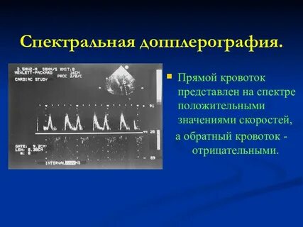 Спектральная допплерография
