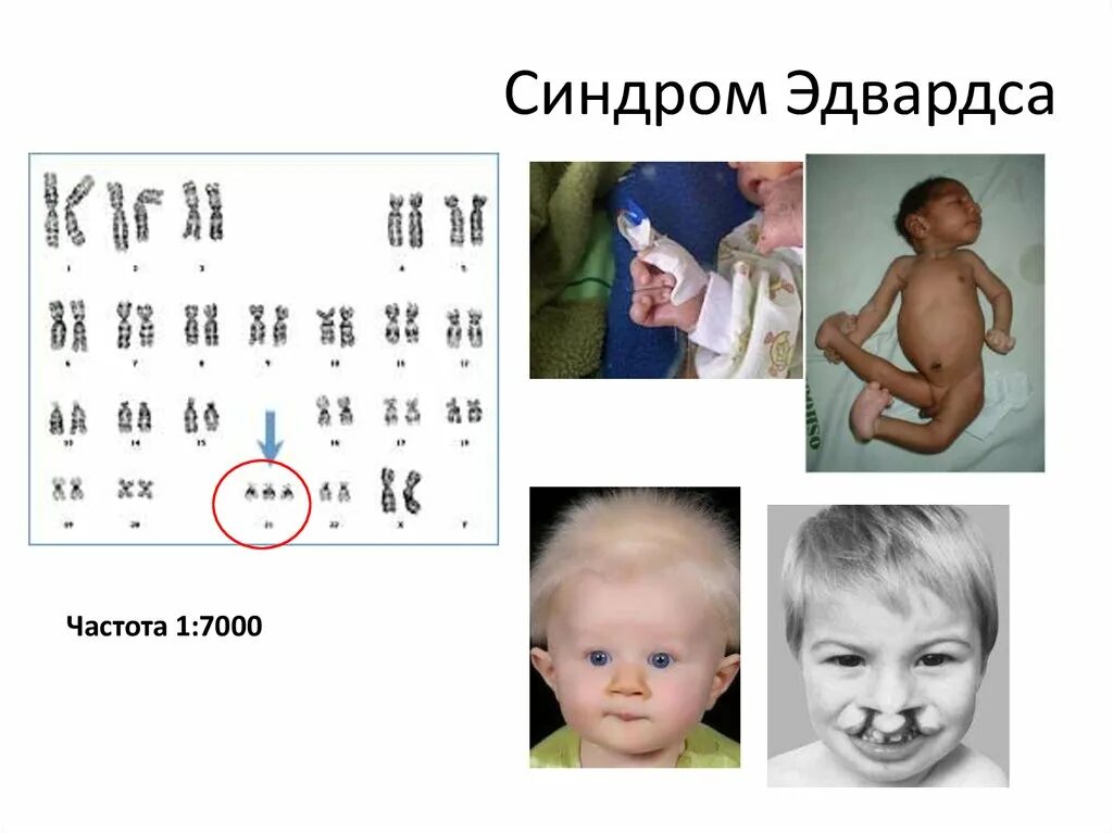 Кариотип заболевания синдром Эдвардса. Кариотип свойственный синдрому Эдвардса. Синдром Эдвардса клинические проявления. Трисомия 18 синдром Эдвардса симптомы.