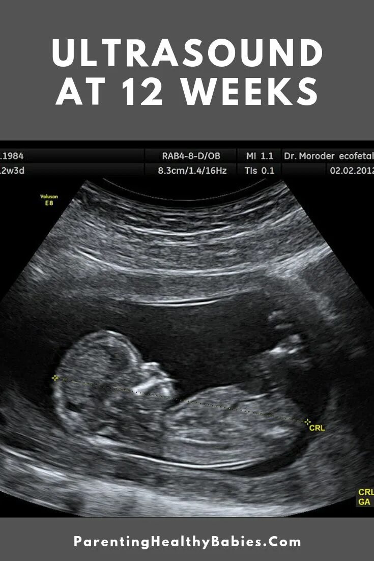 Фото мальчика 12 недель. УЗИ на 14-15 недели беременности пол ребенка. УЗИ при беременности 14 недель. УЗИ ребенка на 12 неделе беременности. УЗИ 11 недель беременности мальчик.