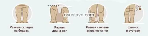 Дисплазия тазобедренных суставов у детей 3 месяца