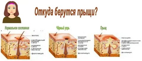 Причины прыщей на лице и теле