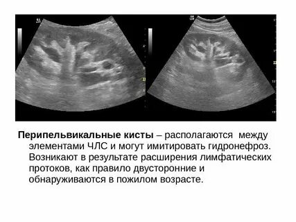 Уплотнение почек на узи что это