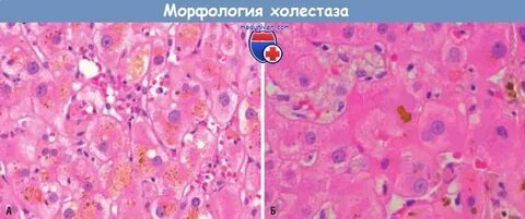 Хронический холестаз печени