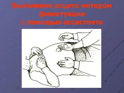 Определение асцита