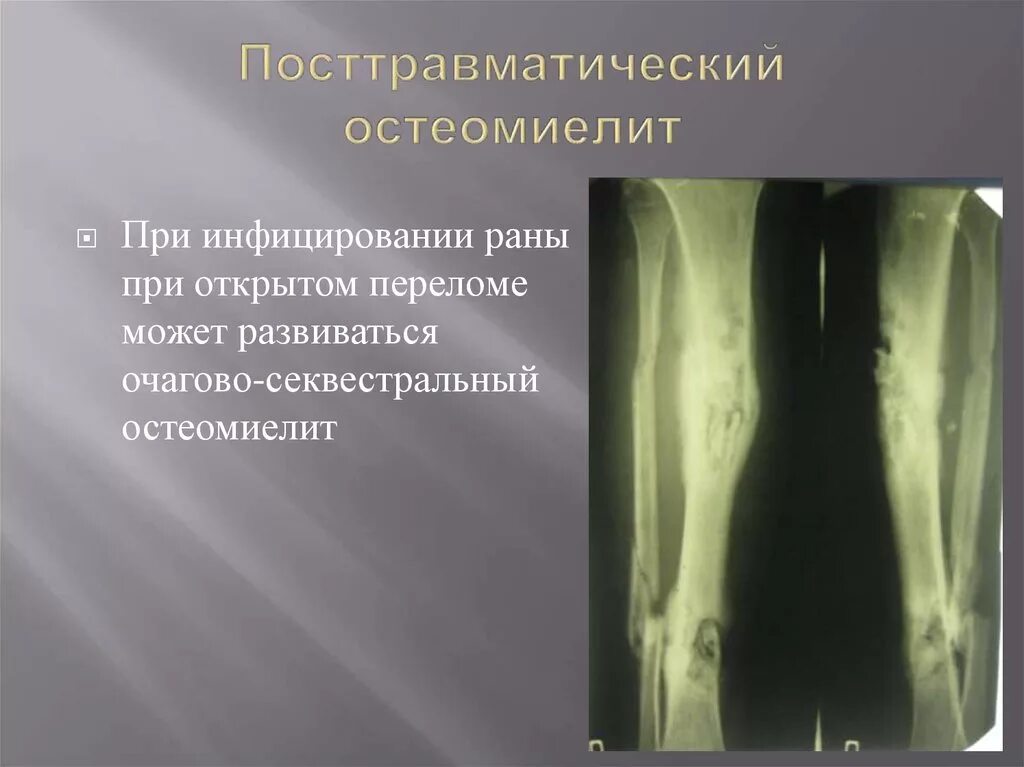 Перелом дефект